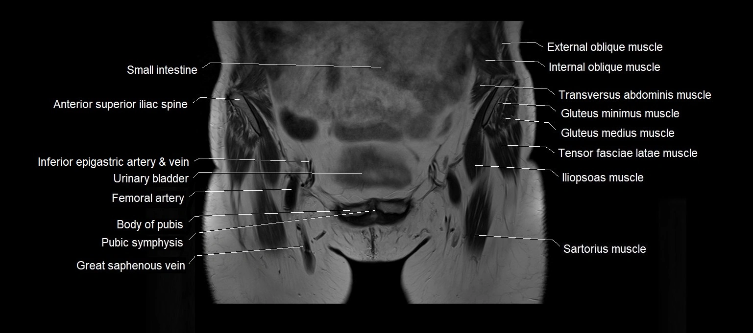 MRI 3T pelvis coronal cross section anatomy image 4.webp